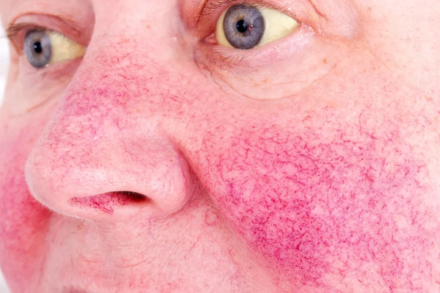 Fatty Liver Symptoms On Face: Signs to Know and When to Seek Help