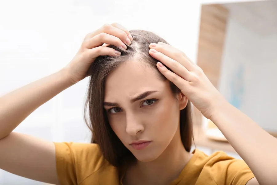 Receding Hairline Causes, Signs, Treatment, and Care Tips